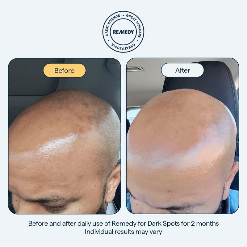 ✨Das REMEDY Overnight Serum: Ihr Kraftpaket im Kampf gegen Pigmentflecken😴