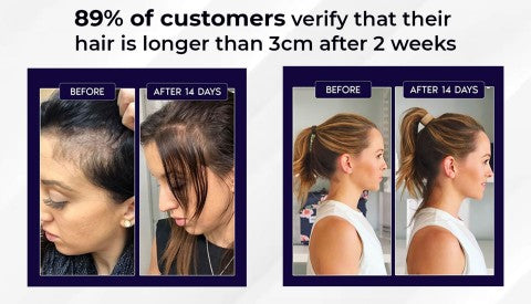 🖤Black Friday Sale 50% OFF🖤 HZA™ Natural Hair Regrowth Spray