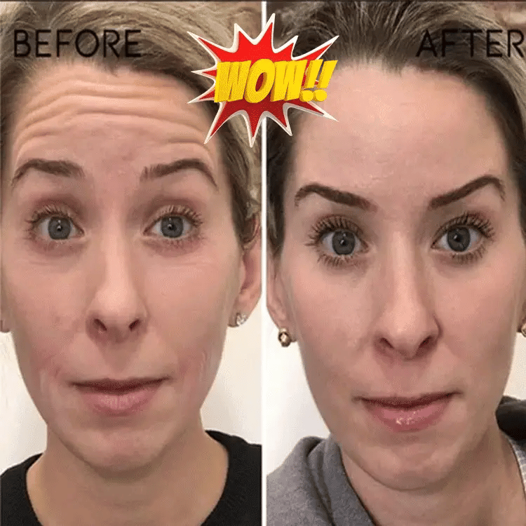 💖DERNIER JOUR DE SOLDES : 50 % DE RÉDUCTION💦essence d'acide hyaluronique