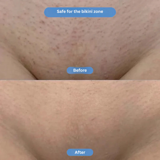 Hosinvest ™ | Bright Bikini Line Serum