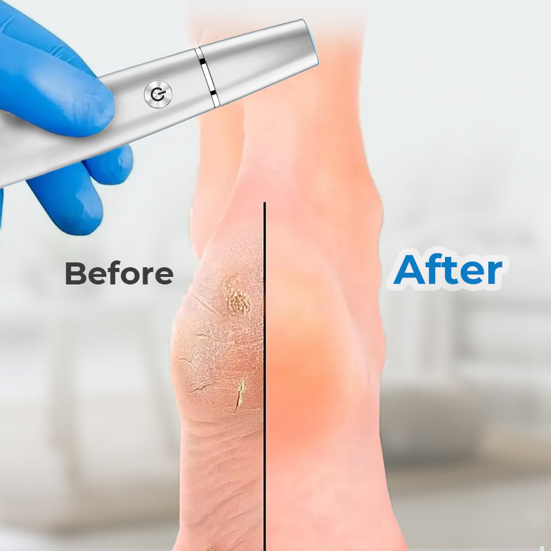 🌸Limited-Time Special!!🌸 Electric Foot Callus Remover