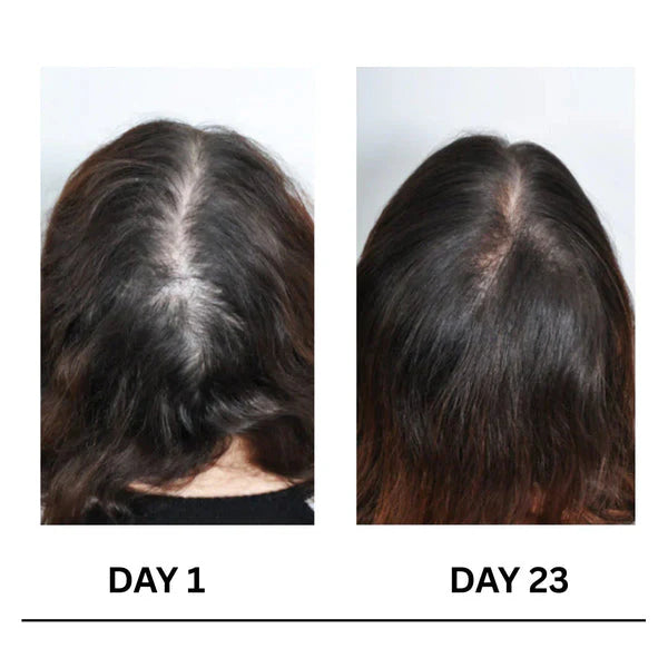 🔥Limited-Time Offer 🌿Scalpy Boost+ Hair Growth