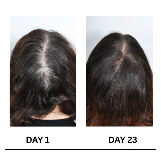 🔥Limited-Time Offer 🌿Scalpy Boost+ Hair Growth