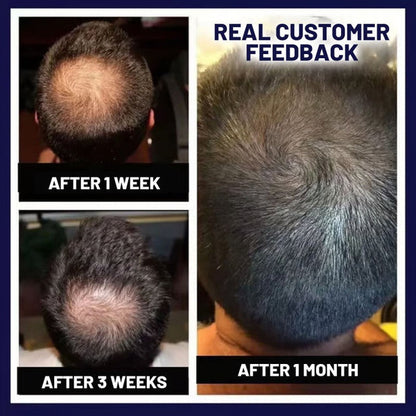 🖤Black Friday Sale 50% OFF🖤 HZA™ Natural Hair Regrowth Spray