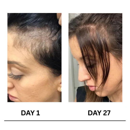 🔥Limited-Time Offer 🌿Scalpy Boost+ Hair Growth