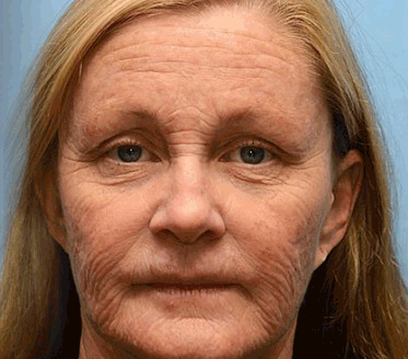 Последване👍| Възвърнете младостта на кожата си 💫STDEI® BOTOX &amp; VITA A RETINOL SHOT Крем за стягане и повдигане на бръчки