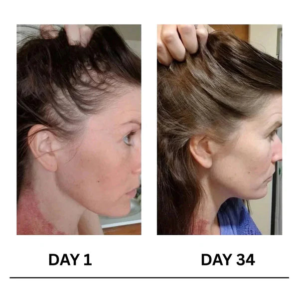 🔥Limited-Time Offer 🌿Scalpy Boost+ Hair Growth