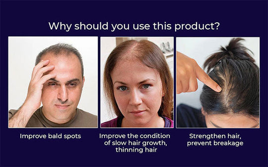 🎅Specjalna oferta świąteczna🌿HZA™ Naturalny spray do odrostu włosów