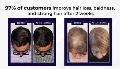 🖤Black Friday Sale 50% OFF🖤 HZA™ Natural Hair Regrowth Spray