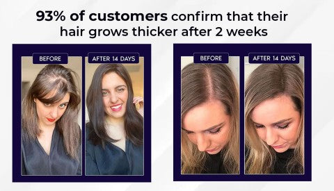 🖤Black Friday Sale 50% OFF🖤 HZA™ Natural Hair Regrowth Spray