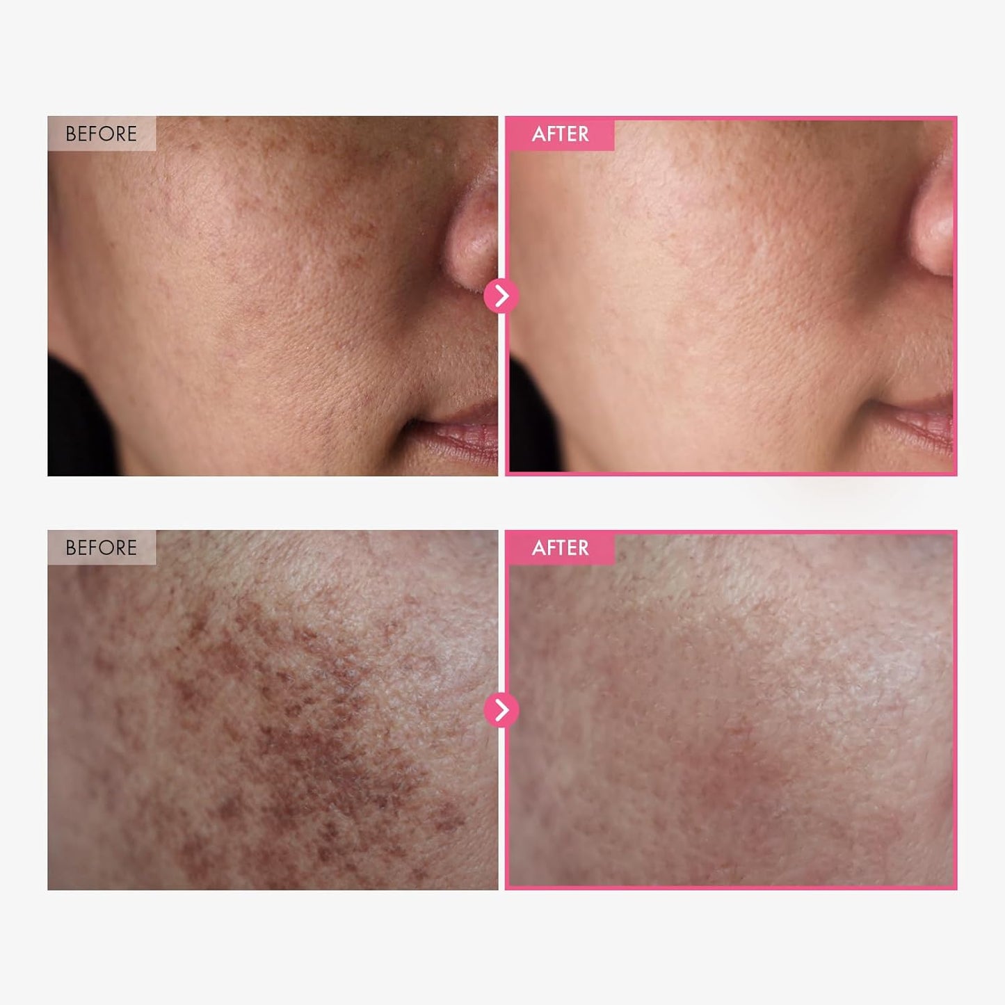 💥Limited Time Sales - 50% OFF💥Arbutin 7% + Tranexamic Acid 4% Cream