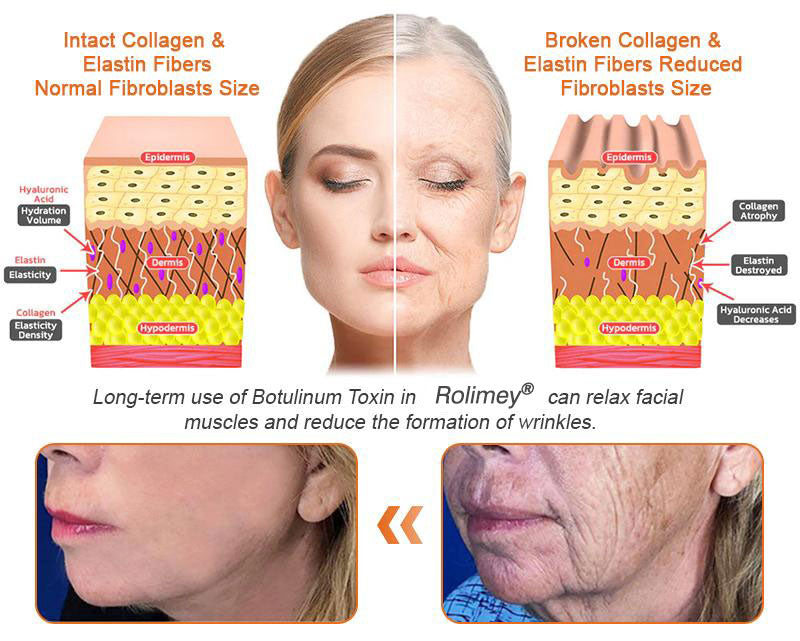 🧑‍⚕️𝑶𝒇𝒇𝒊𝒄𝒊𝒂𝒍 𝑺𝒕𝒐𝒓𝒆 | 𝐑𝐨𝐥𝐢𝐦𝐞𝐲® 𝐁𝐨𝐭𝐨𝐱 𝐁𝐞𝐞 𝐕𝐞𝐧𝐨𝐦 𝐅𝐢𝐫𝐦𝐢𝐧𝐠 𝐒𝐞𝐫𝐮𝐦 𝐒𝐭𝐢𝐜𝐤 - 𝐓𝐚𝐫𝐠𝐞𝐭𝐬 𝐒𝐚𝐠𝐠𝐢𝐧𝐠 𝐒𝐤𝐢𝐧 & 𝐖𝐫𝐢𝐧𝐤𝐥𝐞𝐬 𝐀𝐥𝐥 𝐎𝐯𝐞𝐫 𝐁𝐨𝐝𝐲 𝐰𝐢𝐭𝐡 𝐀𝐝𝐯𝐚𝐧𝐜𝐞𝐝 𝐏𝐞𝐩𝐭𝐢𝐝𝐞 𝐓𝐞𝐜𝐡𝐧𝐨𝐥𝐨𝐠𝐲, 𝐕𝐢𝐬𝐢𝐛𝐥𝐞 𝐑𝐞𝐬𝐮𝐥𝐭𝐬 𝐢𝐧 𝟑 𝐃𝐚𝐲𝐬