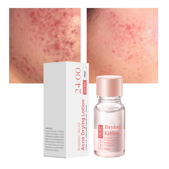 Dr.Leo 24H akne ja vistrikevastane kuivatav kreem | Põletiku leevendus, vistrikejärgne hooldus ja kõrgsurve akne leevendamine