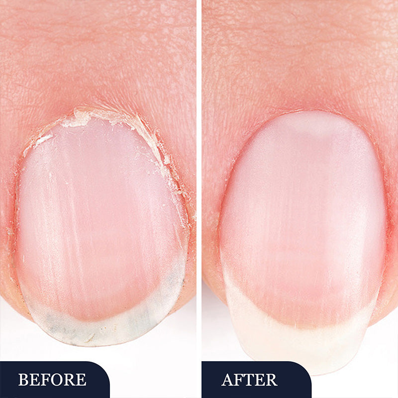 Toenail Fungus Treatment Pen for Damaged Nails